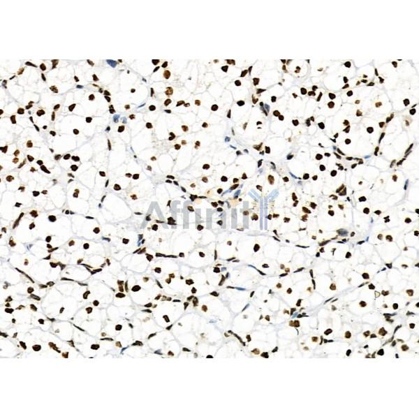 NKAP Antibody - DF9069 at 1/100 staining Human kidney cancer by IHC-P.