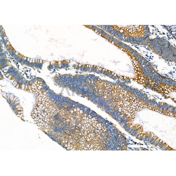 ALKBH7 Antibody - DF9074 at 1/100 staining Human colorectal cancer by IHC-P.
