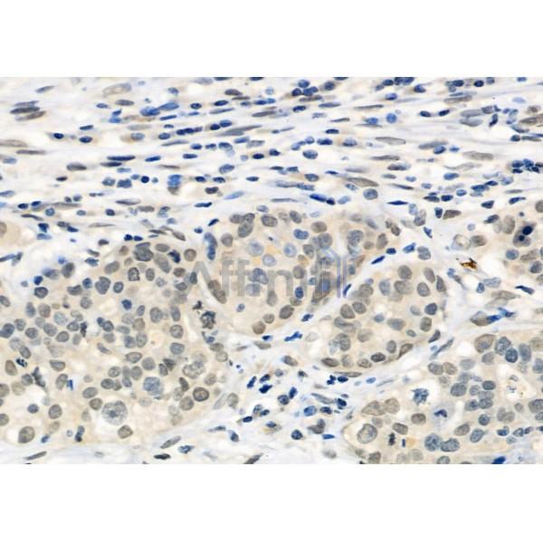 PER1 Antibody - DF9080 at 1/100 staining Human ovarian cancer and adjacent normal tissues by IHC-P.