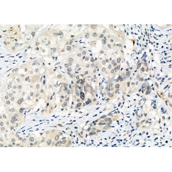 PER1 Antibody - DF9080 at 1/100 staining Human ovarian cancer by IHC-P.