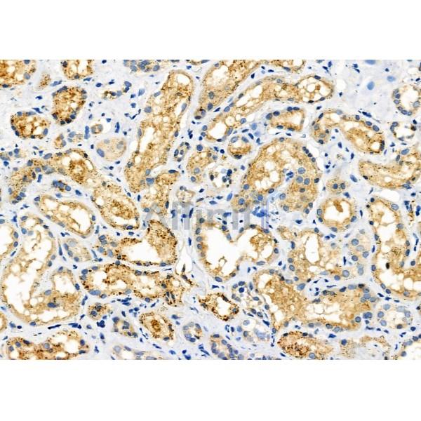 MRPL53 Antibody - DF9113 at 1/100 staining Human kidney cancer and adjacent normal tissues by IHC-P.