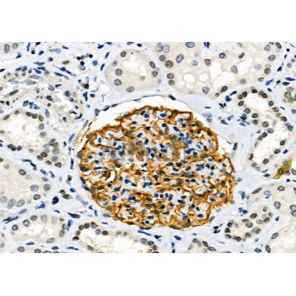 AOAH Antibody - DF9158 at 1/100 staining Human kidney cancer and adjacent normal tissues by IHC-P.