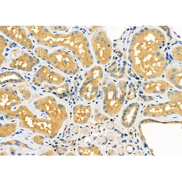 SERPINA2 Antibody - DF9193 at 1/100 staining Human kidney cancer and adjacent normal tissues by IHC-P.