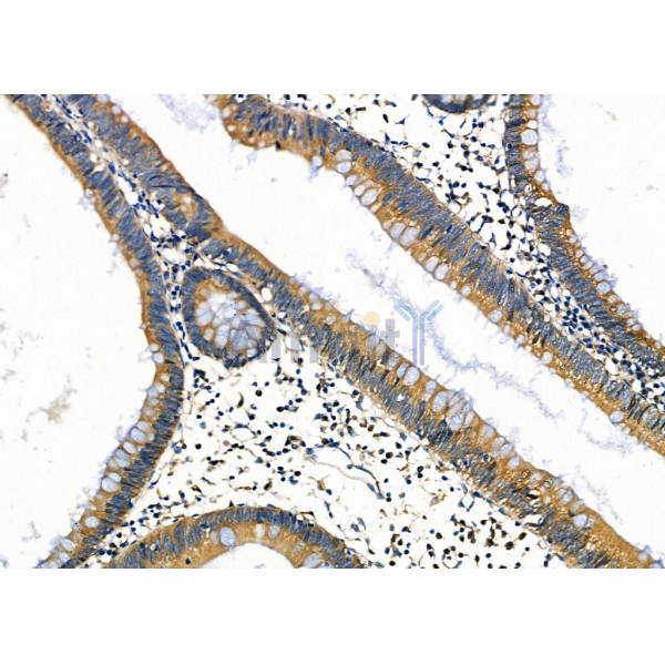 ARSH Antibody - DF9228 at 1/100 staining Human colorectal cancer by IHC-P.