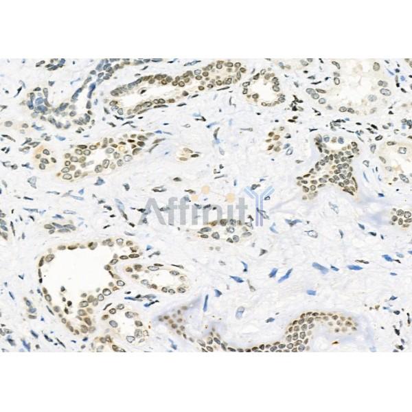PCP4 Antibody - DF9286 at 1/100 staining Human kidney cancer and adjacent normal tissues by IHC-P.