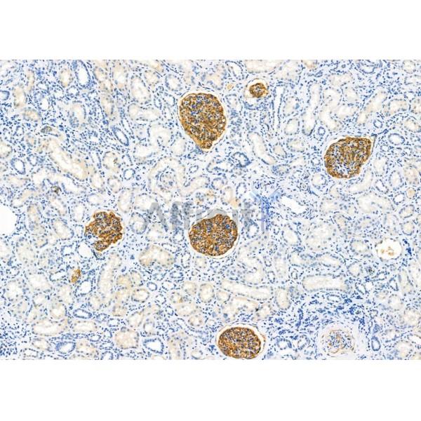 CDR1 Antibody - DF9368 at 1/100 staining Human kidney cancer and adjacent normal tissues by IHC-P.