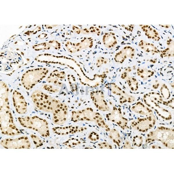 DHRS1 Antibody - DF9434 at 1/100 staining Human kidney cancer and adjacent normal tissues by IHC-P.