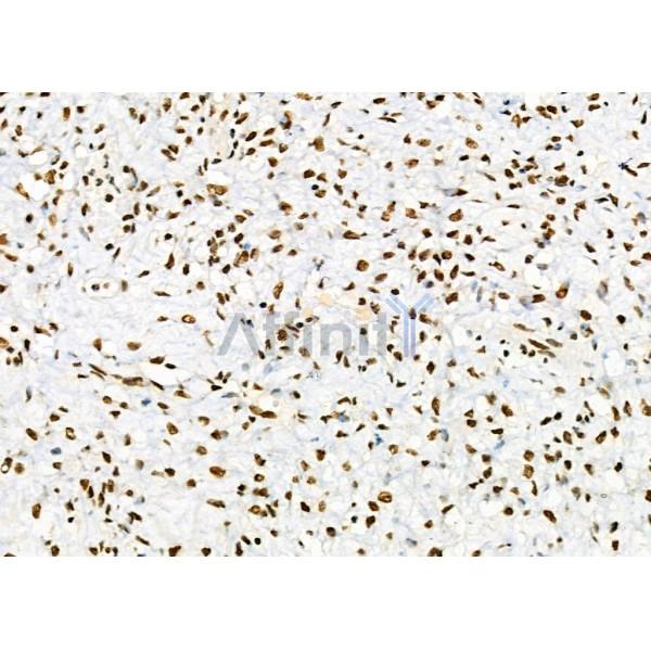 DHRS1 Antibody - DF9434 at 1/100 staining Human ovarian cancer and adjacent normal tissues by IHC-P.