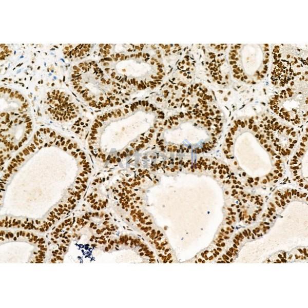 DHRS1 Antibody - DF9434 at 1/100 staining Human ovarian cancer by IHC-P.