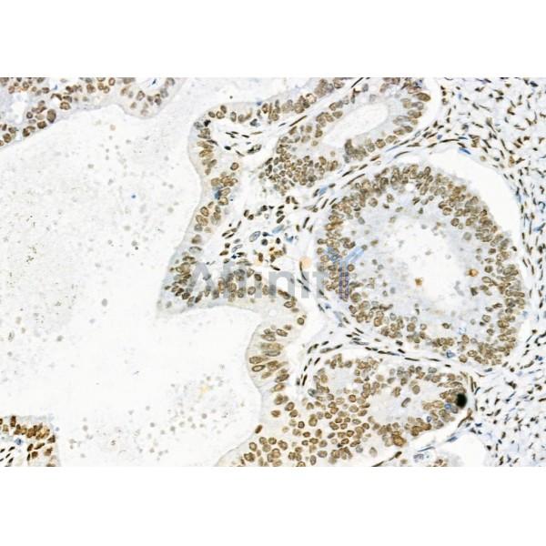 DHRS1 Antibody - DF9434 at 1/100 staining human ovarian cancer by IHC-P.