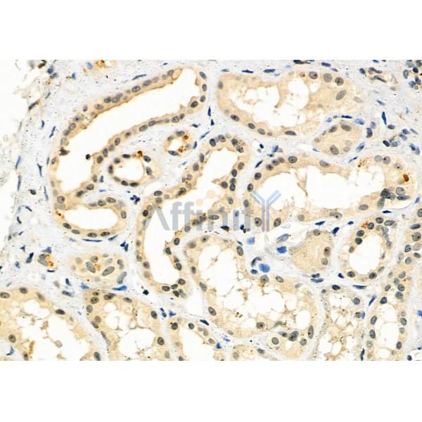 HECTD1 Antibody - DF9478 at 1/100 staining Human kidney cancer and adjacent normal tissues by IHC-P.