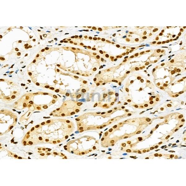 RNF41 Antibody - DF9486 at 1/100 staining Human kidney cancer and adjacent normal tissues by IHC-P.
