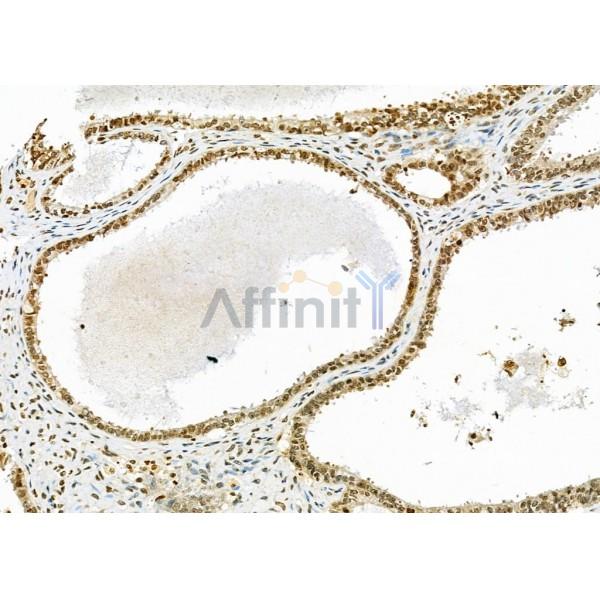 RNF41 Antibody - DF9486 at 1/100 staining Human ovarian cancer by IHC-P.