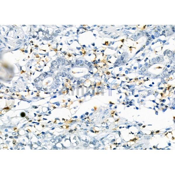 RNF167 Antibody - DF9489 at 1/100 staining Human gastric cancer by IHC-P.