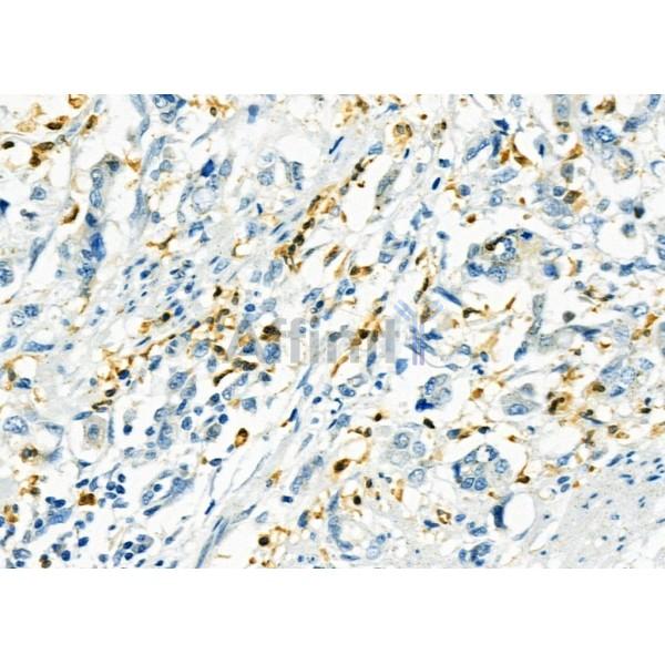RNF167 Antibody - DF9489 at 1/100 staining Human colorectal cancer by IHC-P.