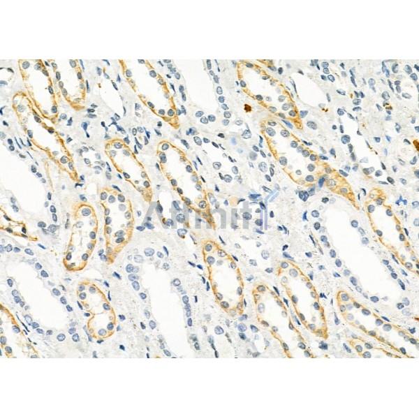 RNF167 Antibody - DF9489 at 1/100 staining Human kidney cancer and adjacent normal tissues by IHC-P.