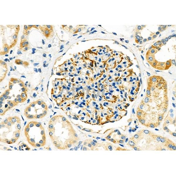 USP54 Antibody - DF9595 at 1/100 staining Human kidney cancer and adjacent normal tissues by IHC-P.