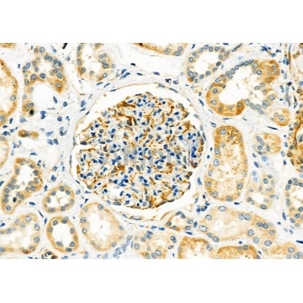 USP54 Antibody - DF9595 at 1/100 staining Human kidney cancer and adjacent normal tissues by IHC-P.