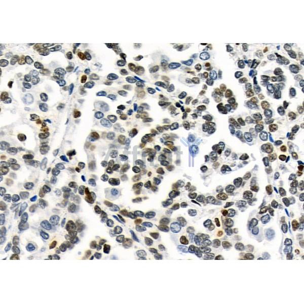 MED29 Antibody - DF9616 at 1/100 staining Human kidney cancer by IHC-P.