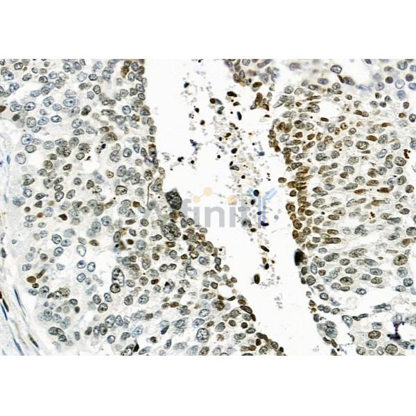 MED29 Antibody - DF9616 at 1/100 staining Human ovarian cancer by IHC-P.