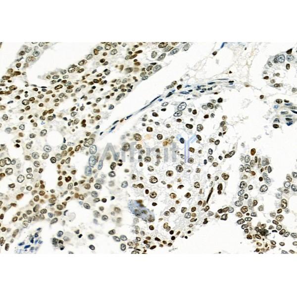 MED29 Antibody - DF9616 at 1/100 staining Human ovarian cancer by IHC-P.
