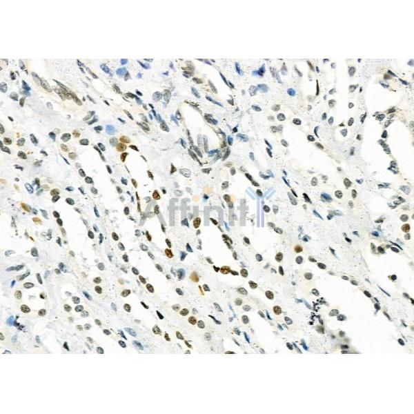 MED29 Antibody - DF9616 at 1/100 staining Human kidney cancer and adjacent normal tissues by IHC-P.