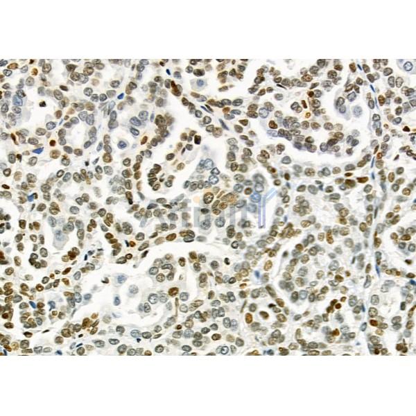 MED29 Antibody - DF9616 at 1/100 staining Human kidney cancer by IHC-P.