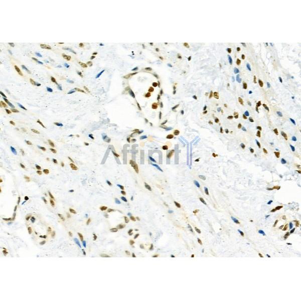 MED29 Antibody - DF9616 at 1/100 staining Human ovarian cancer and adjacent normal tissues by IHC-P.