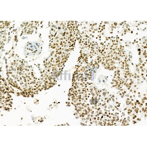 MED29 Antibody - DF9616 at 1/100 staining Human ovarian cancer by IHC-P.