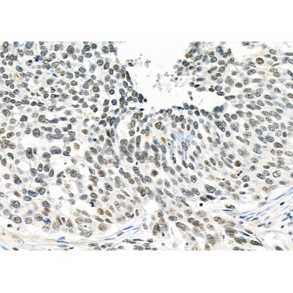 MED31 Antibody - DF9618 at 1/100 staining Human ovarian cancer by IHC-P.