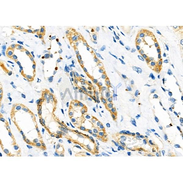 MEGF6 Antibody - DF9644 at 1/100 staining Human kidney cancer and adjacent normal tissues by IHC-P.