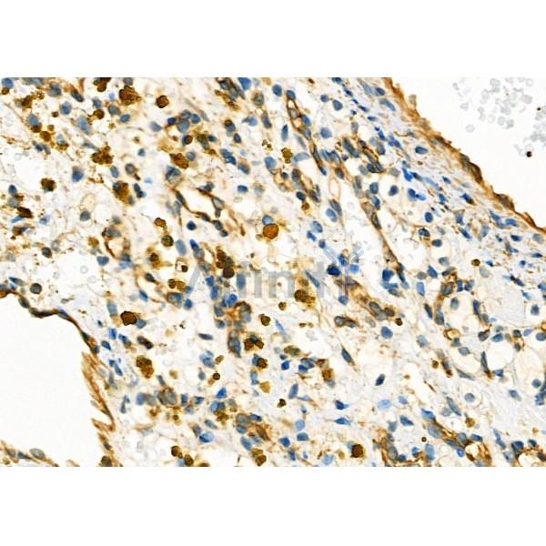 MYO5C Antibody - DF9653 at 1/100 staining Human kidney cancer by IHC-P.