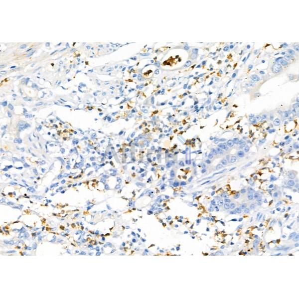 RAB19 Antibody - DF9816 at 1/100 staining Human gastric cancer by IHC-P.