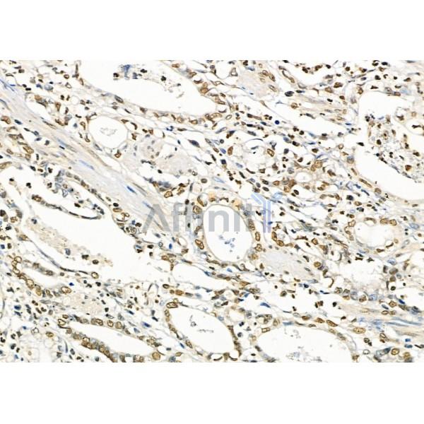 RFPL2 Antibody - DF9850 at 1/100 staining Human gastric cancer by IHC-P.