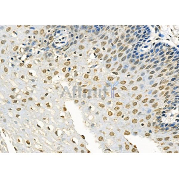 RFPL2 Antibody - DF9850 at 1/100 staining Human esophageal cancer and adjacent normal tissues by IHC-P.