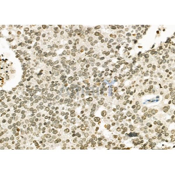 RFPL2 Antibody - DF9850 at 1/100 staining Human ovarian cancer by IHC-P.