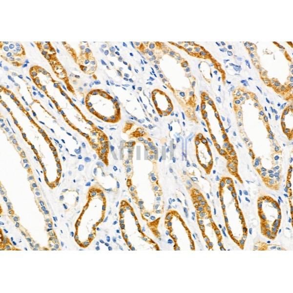 RHG28 Antibody - DF9860 at 1/100 staining Human kidney cancer and adjacent normal tissues by IHC-P.
