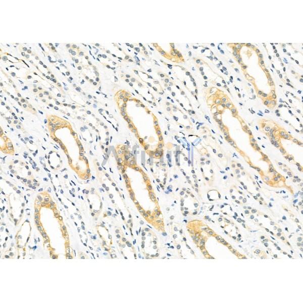 TRAPPC1 Antibody - DF9964 at 1/100 staining Human kidney cancer and adjacent normal tissues by IHC-P.