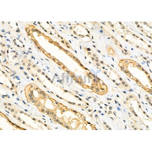 TCEAL5 Antibody - DF9968 at 1/100 staining Human kidney cancer and adjacent normal tissues by IHC-P.