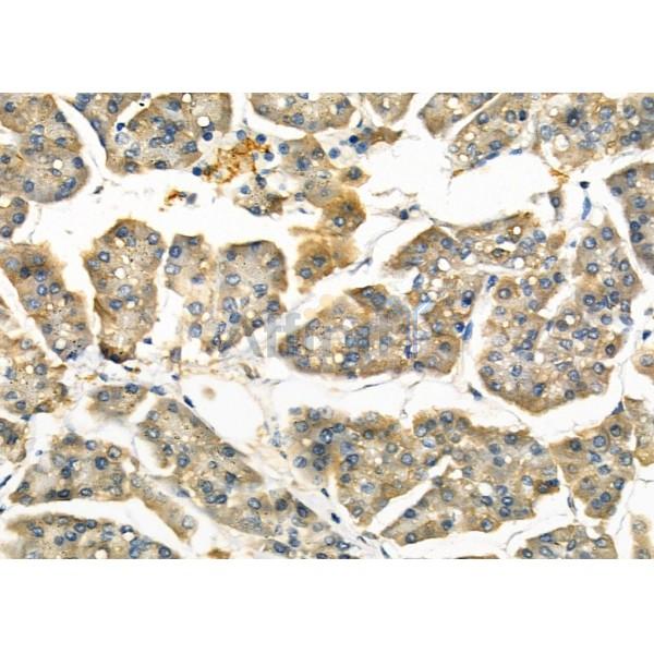 IF3EI Antibody - AF0640 at 1/100 staining Human pancreatic cancer and adjacent nomal tissues by IHC-P.