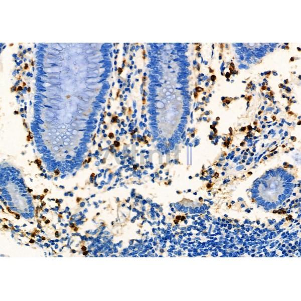 CD8 Antibody - AF5126 at 1/100 staining Human colorectal cancer by IHC-P.