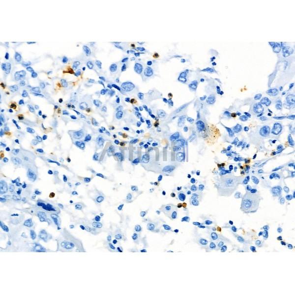 CD8 Antibody - AF5126 at 1/100 staining Human lung cancer by IHC-P.