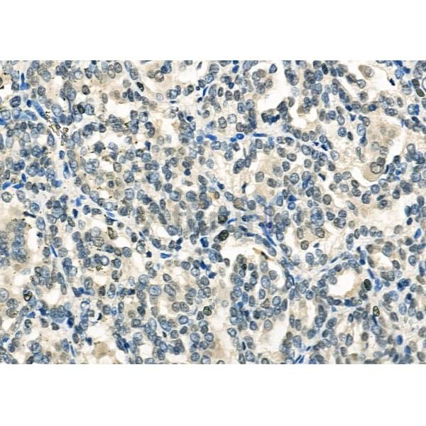 DHX9 Antibody - DF12266 at 1/100 staining Human kidney cancer by IHC-P.