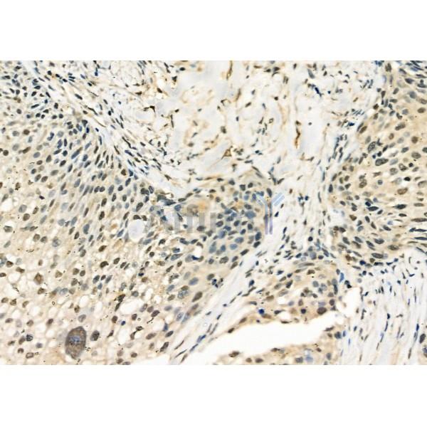 DHX9 Antibody - DF12266 at 1/100 staining Human ovarian cancer by IHC-P.