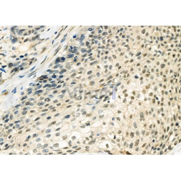 DHX9 Antibody - DF12266 at 1/100 staining Human ovarian cancer by IHC-P.