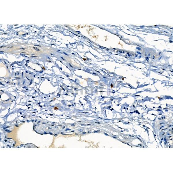 Mast Cell Chymase Antibody - DF12290 at 1/100 staining Human colorectal cancer by IHC-P.