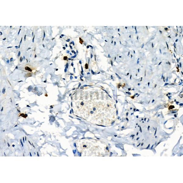 Mast Cell Chymase Antibody - DF12290 at 1/100 staining Human ovarian cancer and adjacent normal tissues by IHC-P.