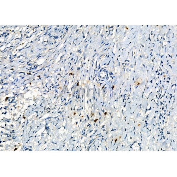 Mast Cell Chymase Antibody - DF12290 at 1/100 staining Human ovarian cancer by IHC-P.
