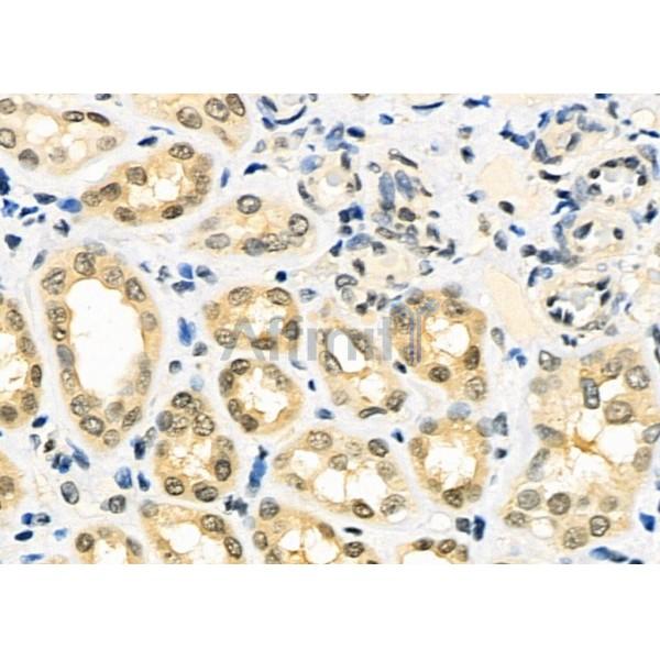 MEPCE Antibody - DF12294 at 1/100 staining Human kidney cancer and adjacent normal tissues by IHC-P.