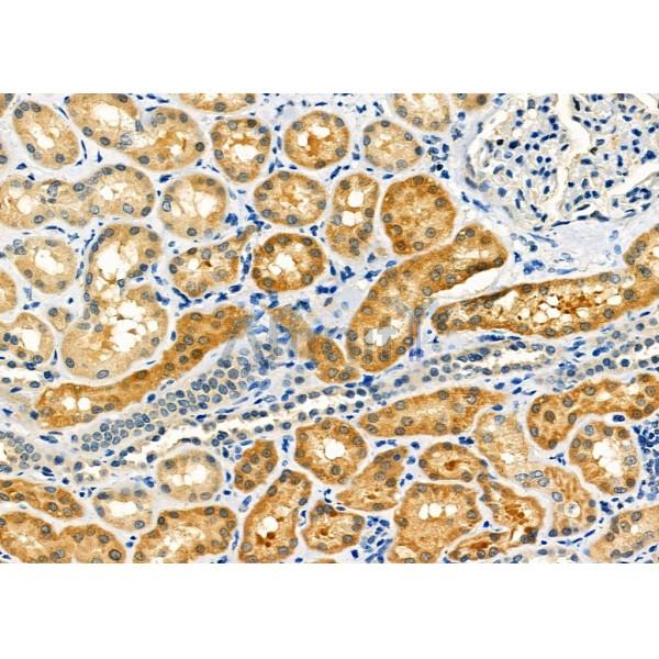 MLXIP Antibody - DF12296 at 1/100 staining Human kidney cancer and adjacent normal tissues by IHC-P.